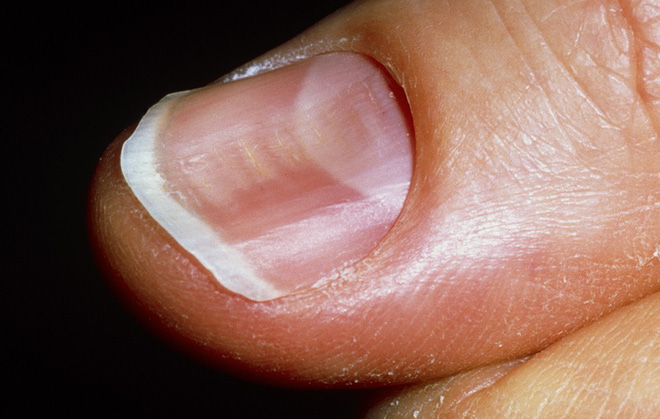 Dấu hiệu bất thường ở móng tay: cảnh báo bệnh tiểu đường